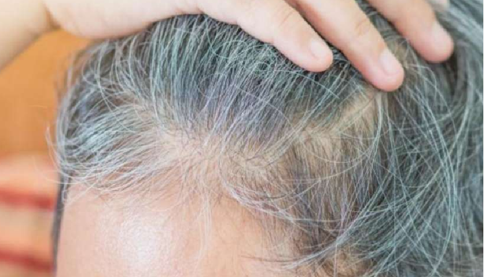 Natural Home Remedies For Grey Hair  PharmEasy Blog