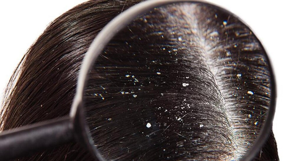 Dandruff Remedies: बालों में सिर्फ तेल लगाने से बढ़ सकता है डैंड्रफ, जानें असरदार उपाय