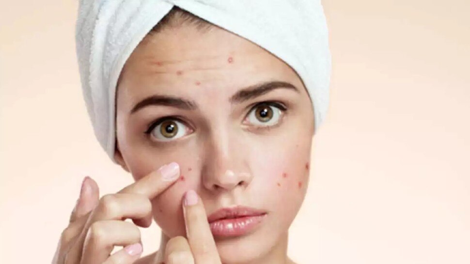treatment of pimples problem: जानिए चेहरे पर क्यों आते हैं मुंहासे, इन्हें जड़ से खत्म कर देंगे यह घरेलू उपाय