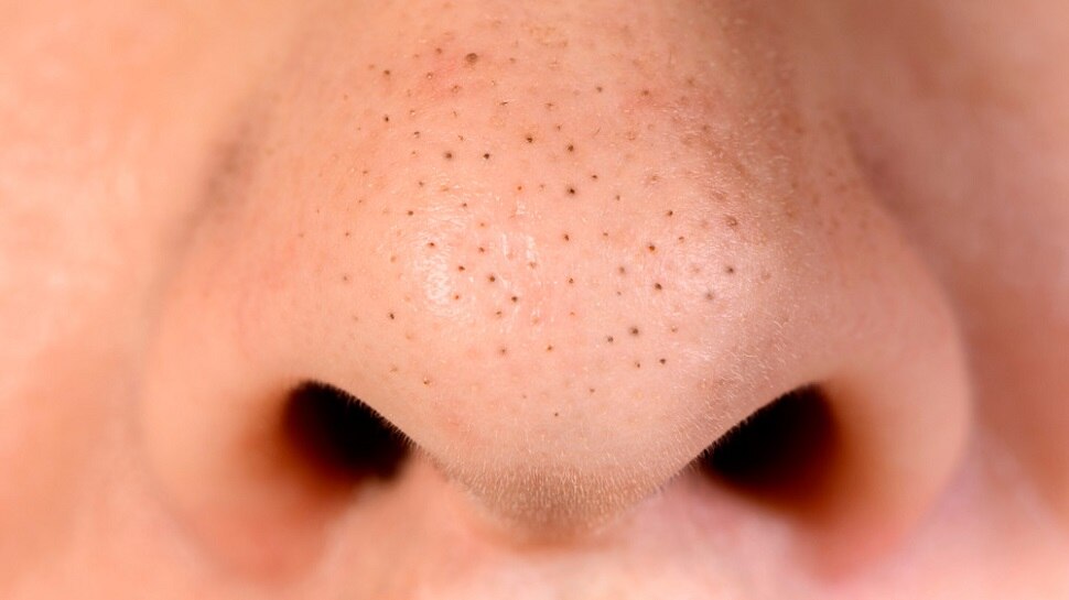 Blackheads हटाने में असरदार है सिर्फ 1 अंडा, जानें इस्तेमाल करने का सही तरीका