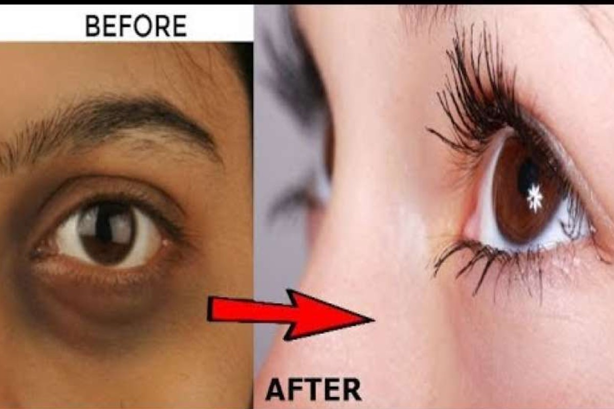 how to remove dark circles: घर बैठे इस तरह हटाएं आंखो के नीचे मौजूद काले घेरे, चेहरा दिखने लगेगा खूबसूरत