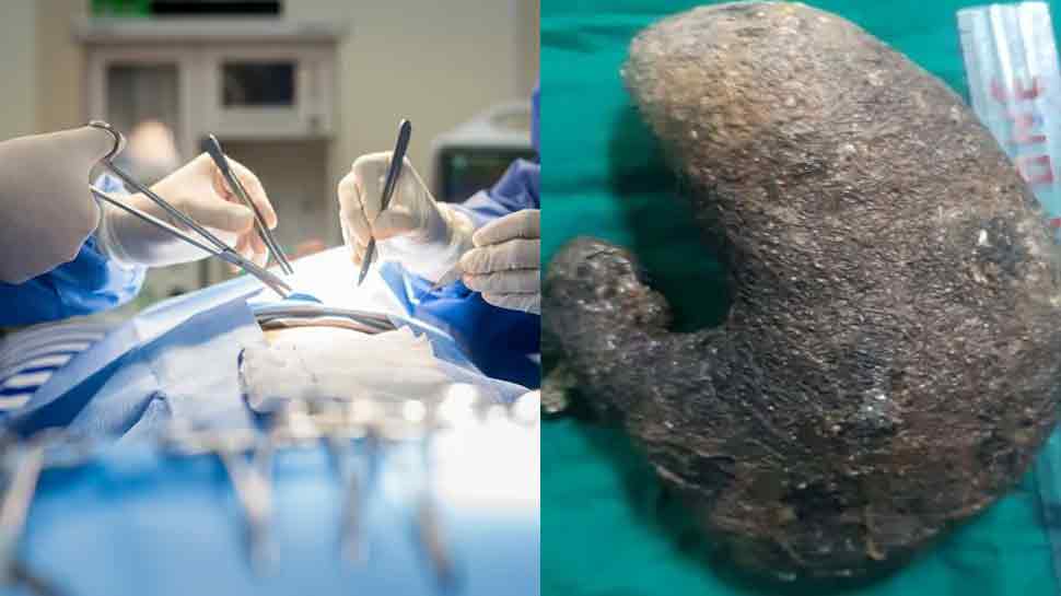 लखनऊ: अपने ही सिर के बालों को खाती थी लड़की, डॉक्टरों ने ​पेट से निकाली 2 किलो वजनी गांठ