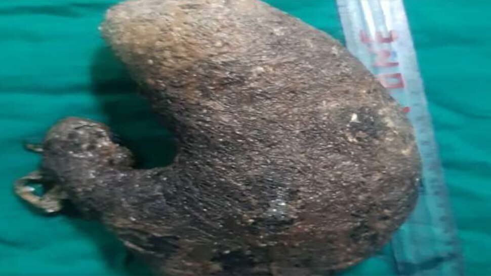 17 साल की लड़की 5 सालों में खा गई अपने सिर के दो किलो बाल, डॉक्टर्स ने ऑपरेशन कर बचाई जान