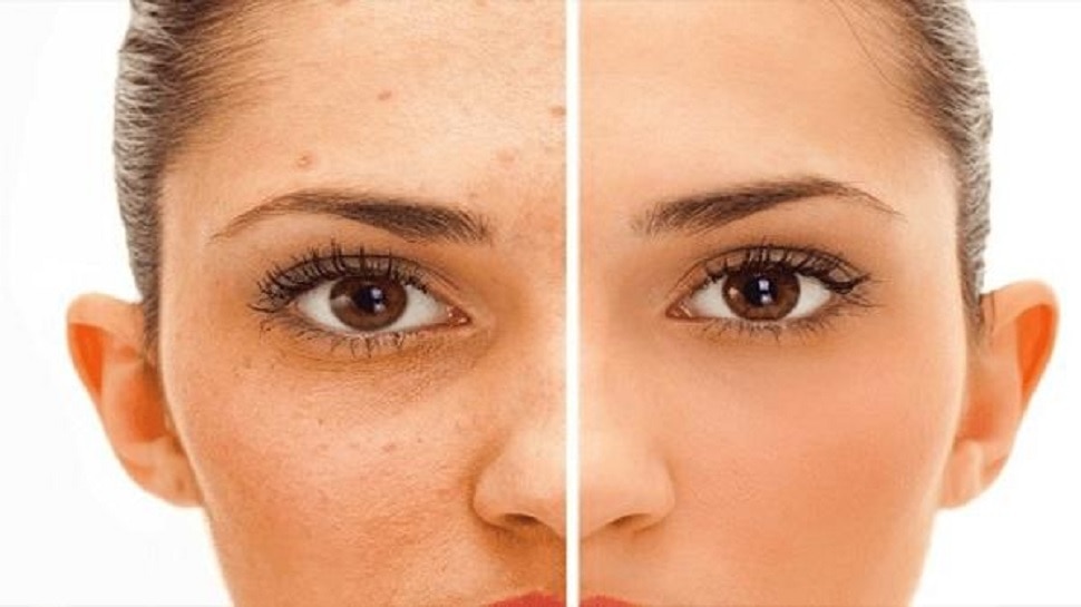 Dark Spots on face: दाग-धब्बे मिटाने में अदरक कैसे करता है मदद, जानें यहां