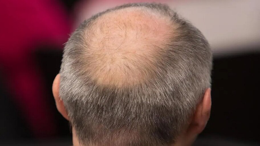 Yoga for hair : रोज 5 मिनट ये योग करने से कभी नहीं होंगे गंजे, लंबे और मजबूत बनेंगे बाल