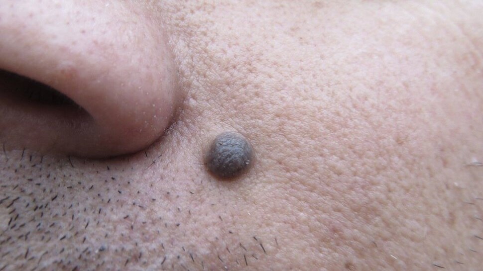 Mole Removal : चेहरे से मस्सा हटाना है, तो बस इस तेल का कर लें इस्तेमाल, जान लें सही तरीका