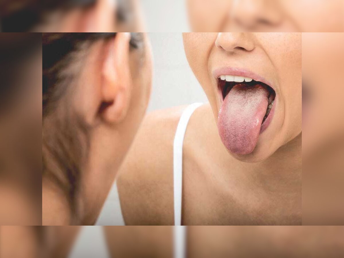 मुंह में Ulcer और इन लक्षणों को न करें नजरअंदाज, हो सकते हैं Tongue Cancer के संकेत