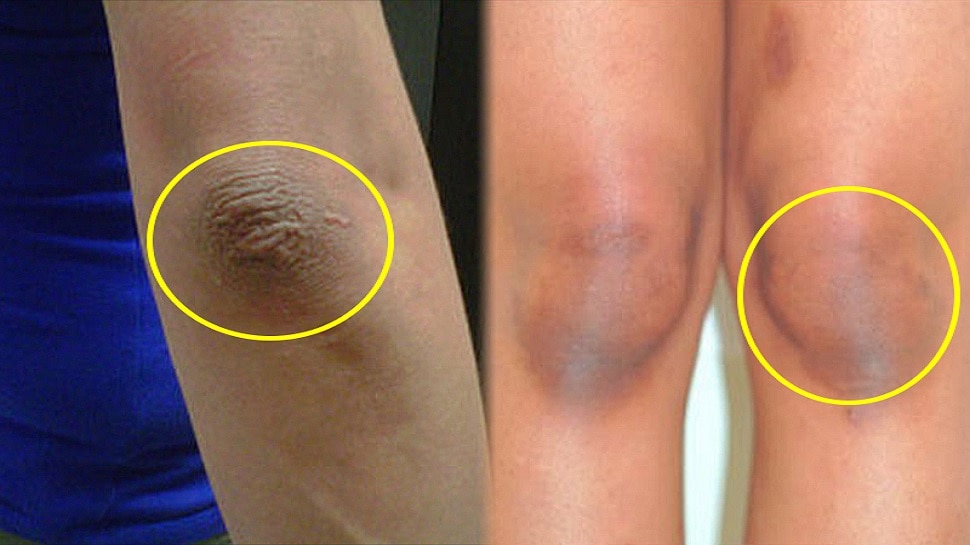 Dark Elbow and Knees: कोहनी और घुटनों से कालापन हटा देगा ये उपाय, आजमा कर खुद देखें रिजल्ट