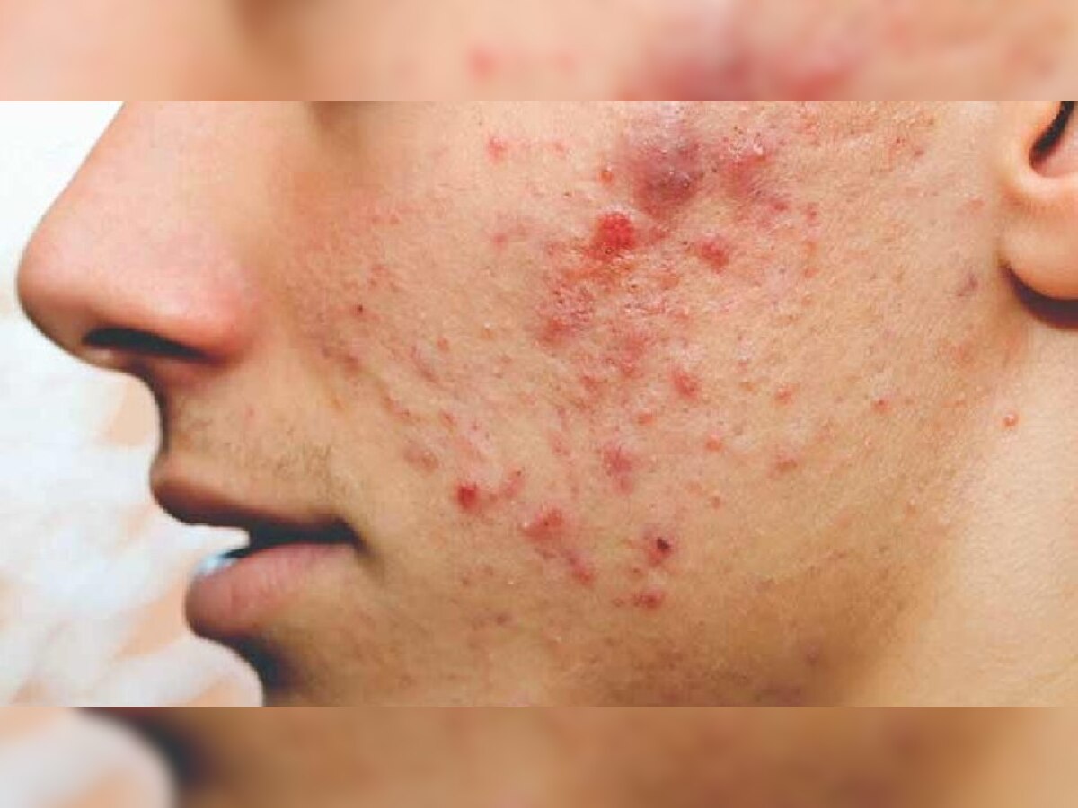 Treatment of pimples problem