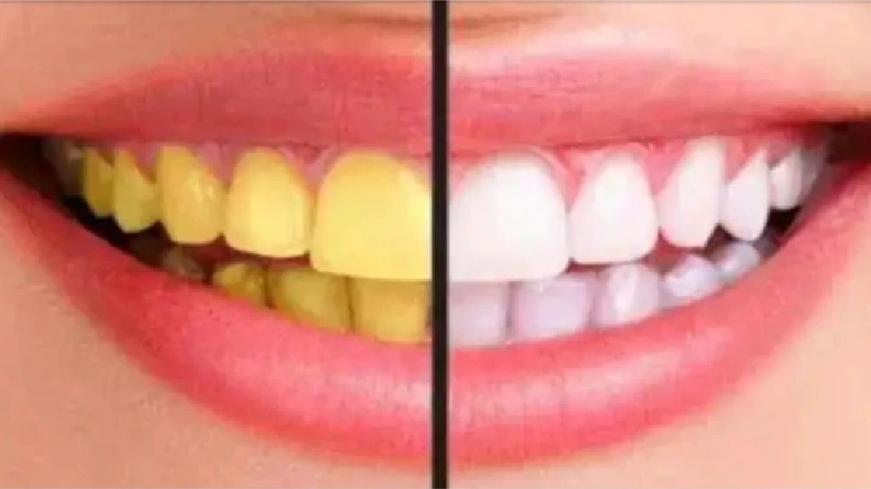 Oral Health News: दांतों का पीलापन दूर कर देंगे यह 3 असरदार उपाय, जानिए...