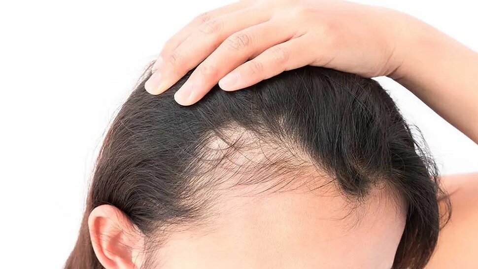 Hair Loss in Women: महिलाओं में ना आ जाए गंजापन, हेयर फॉल रोकने के लिए अभी से अपनाएं ये टिप्स