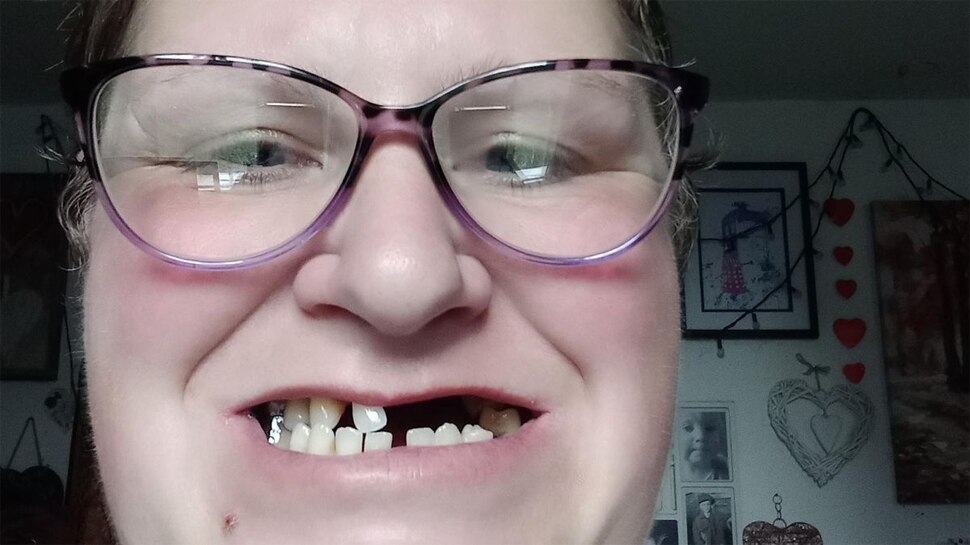 Private Dentist के पास जाने के नहीं थे पैसे, महिला ने खुद उखाड़ डाले 11 दांत; अब हो गया ऐसा हाल