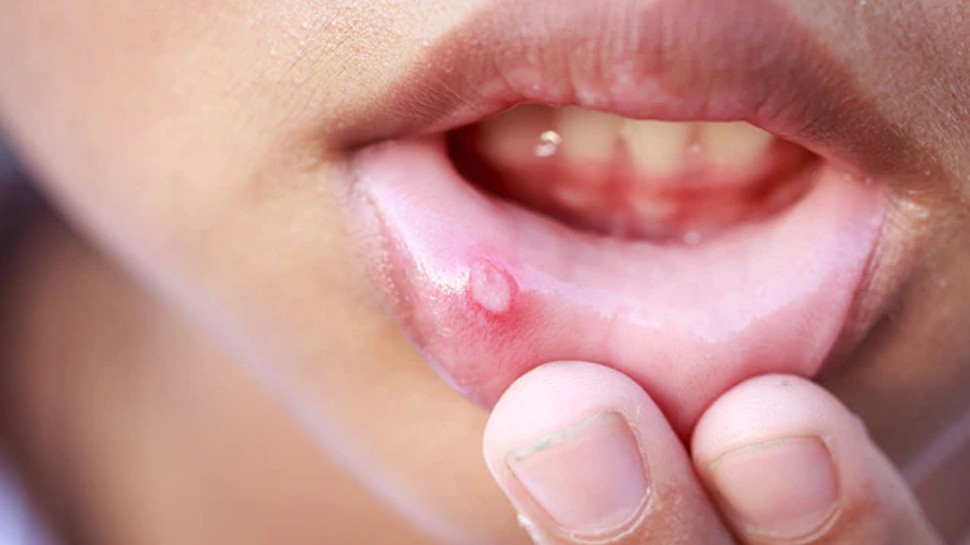 Mouth Ulcers Treatment: आपके भी मुंह में हो जाते हैं छाले तो अपना लीजिए ये उपाय, तुरंत मिलेगी राहत!