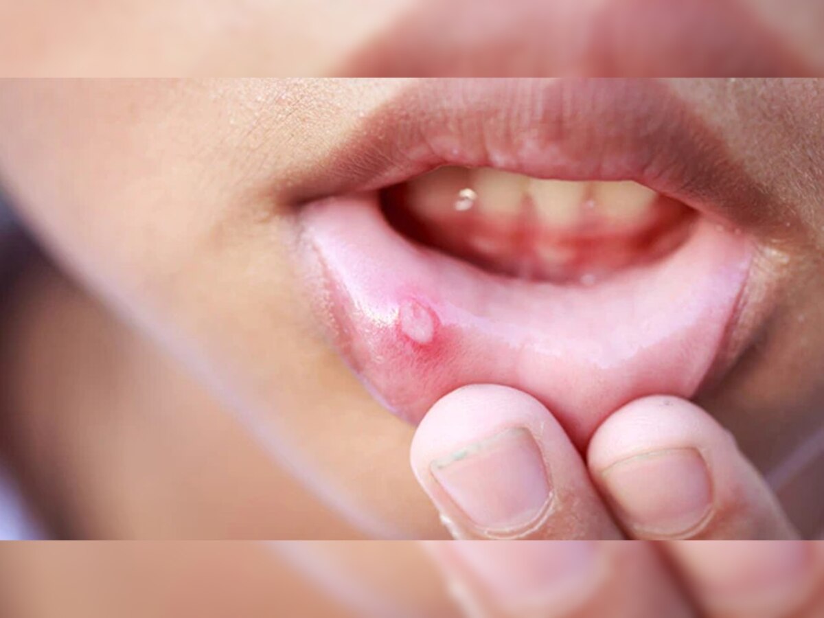 Mouth Ulcers Treatment