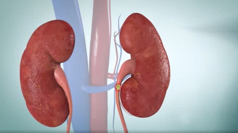 Kidney Fail: किडनियों को खराब करती हैं ये 5 आदतें, किडनी फेल होने से पहले दिखते हैं ये लक्षण