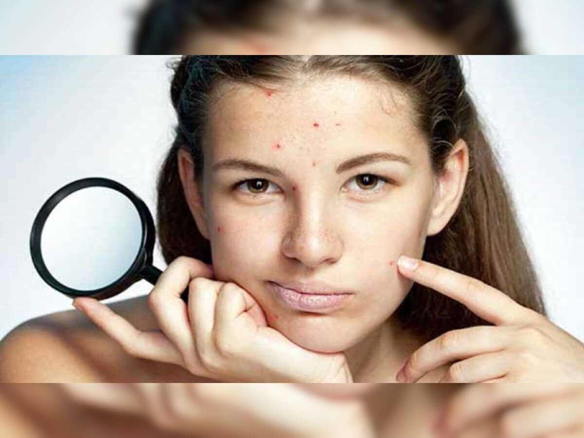 How To Remove Pimple