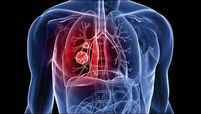 ਕੋਵਿਡ 19 ਵਾਂਗ ਘਾਤਕ ਵਾਇਰਸ ਹੈ Tuberclosis
