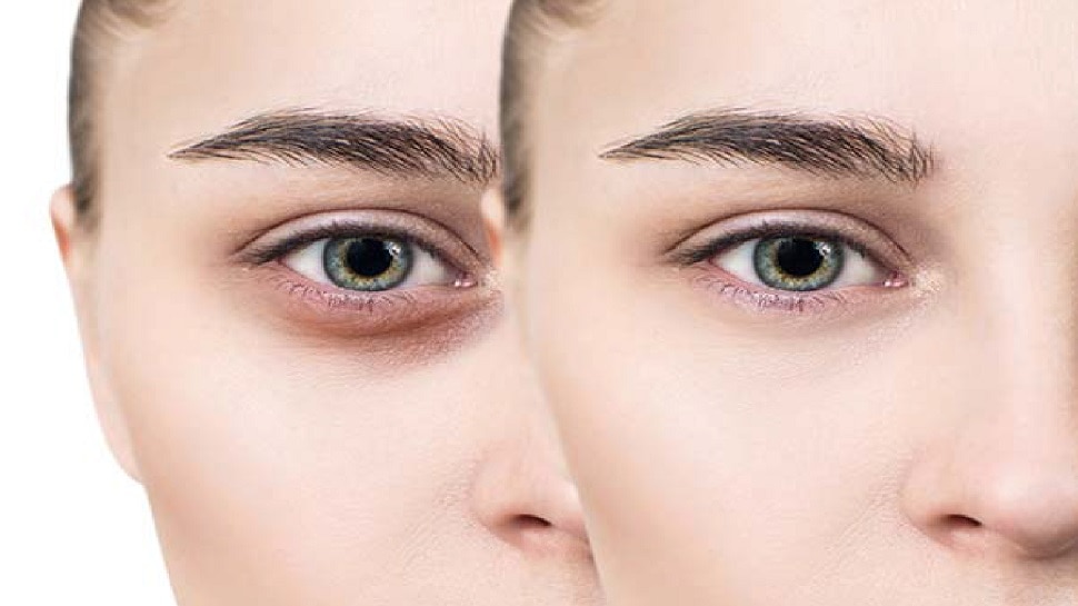 Dark eye circles: काले घेरे हटाने के लिए शाम को चार बजे खाएं ये Snack, त्वचा पर नहीं रहेगा कोई निशान