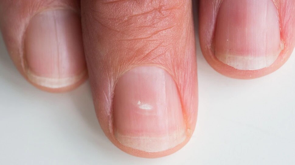 Nails Signs: चेक कीजिए नाखून पर निशान! सही समय पर पहचान लें वरना हो जाएगी देरी
