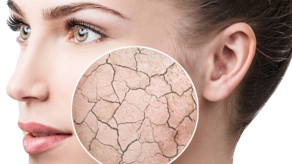 Remedies for dry skin:आपकी स्किन भी रहती है ड्राई तो चेहरे पर लगाएं ये चीजें, वापस लौट आएगा ग्लो, चमक उठेगा चेहरा