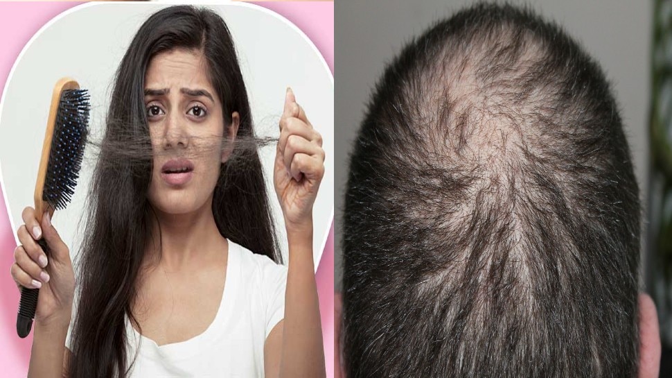 hair loss front of head female Hair Loss कय मथ स गयब ह रह ह  सर क बल त जन गजपन क य 5 नशन  hair loss baldness causes  symptoms in