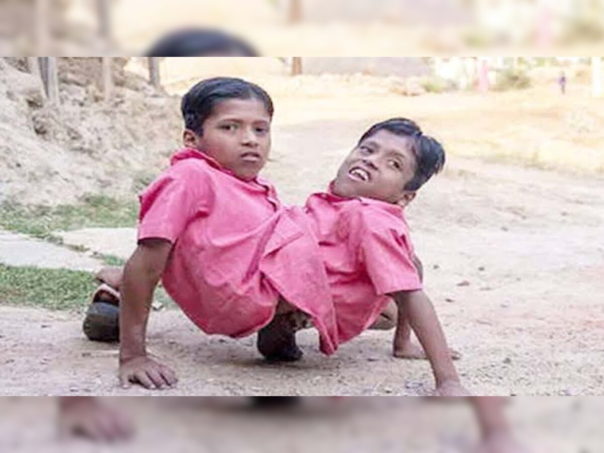 एक जिस्म दो जानः जुड़वा भाई शिवनाथ-शिवराम की बीमारी से हुई मौत, दोनों का वीडियो हुआ था वायरल