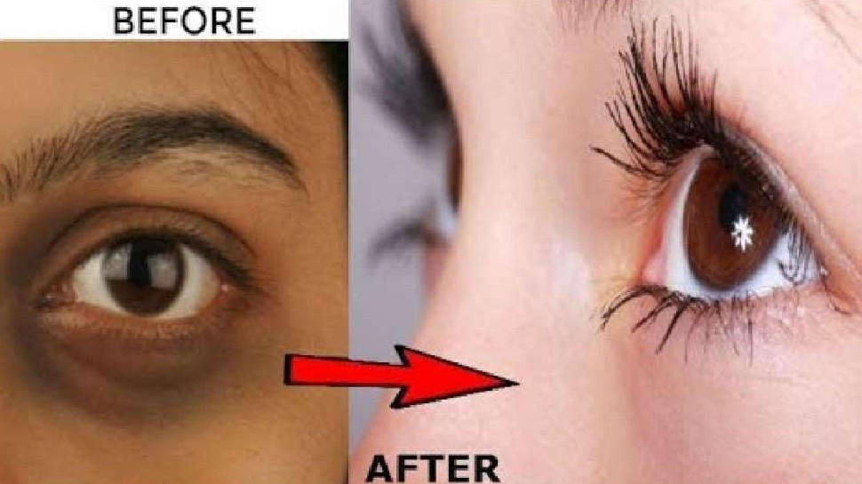Remove dark circles under eyes with milk know Milk is helpful in