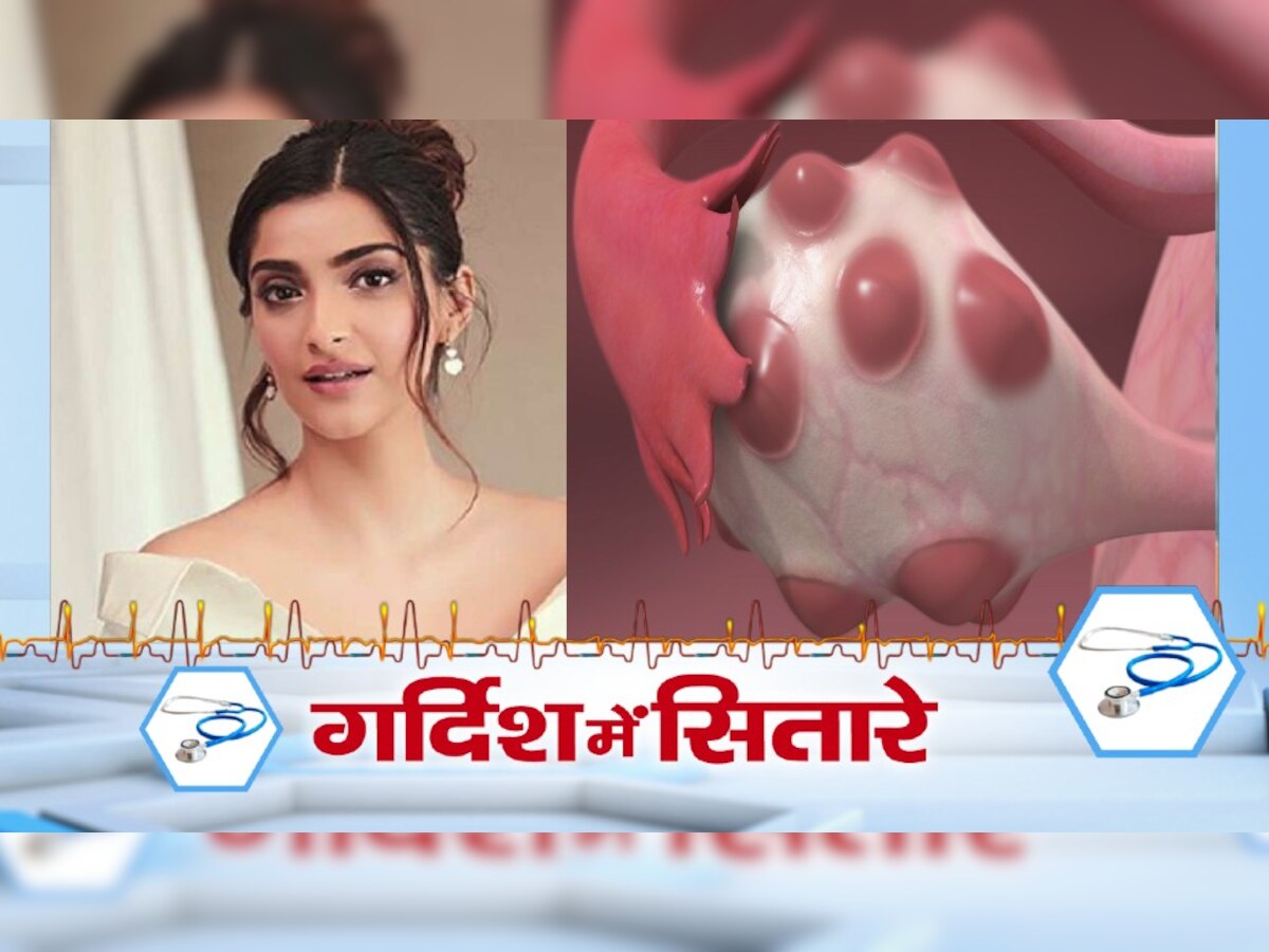 Sonam Kapoor is suffered from polycystic ovary syndrome