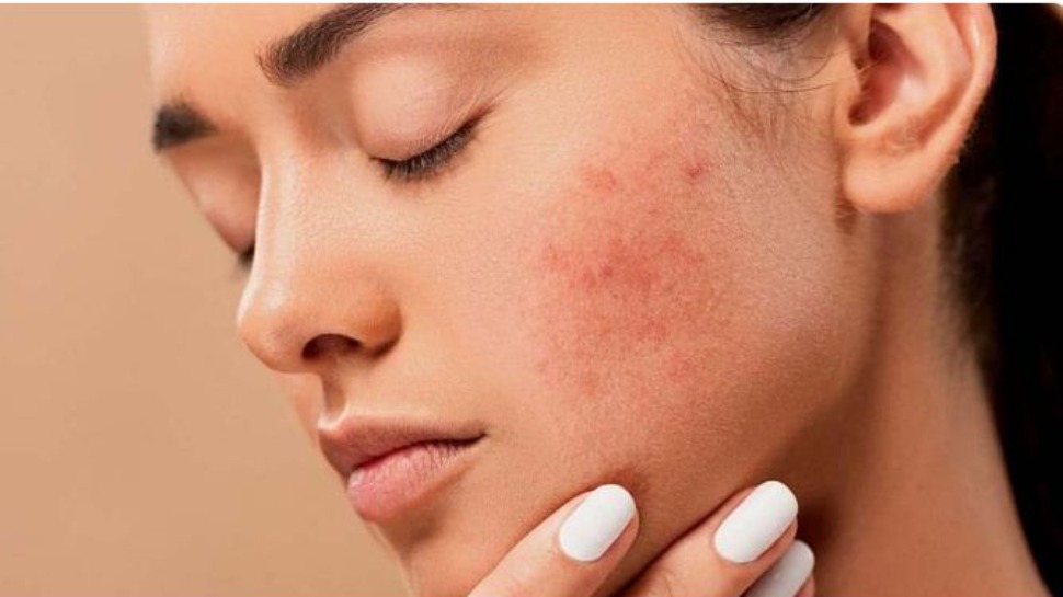 What Is Winter Rash Causes Symptoms Risk Factors and Treatments ...