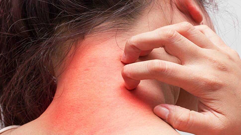 Skin Problems in Winters: सर्दियों में इस विटामिन की कमी से बढ़ सकती है स्किन प्रॉब्लम्स, जानें बचाव का तरीका