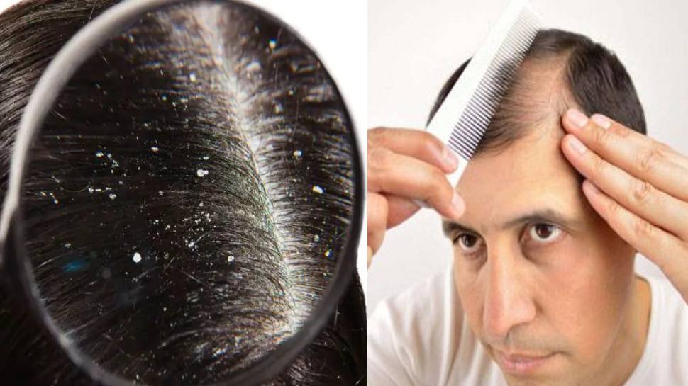 Causes of Ingrown Hair and Ways To Get Rid Of Ingrown Hair In Hindi  अदर  क तरफ उगन वल बल इनगरन हयर स छटकर पन क लए अपनए य उपय