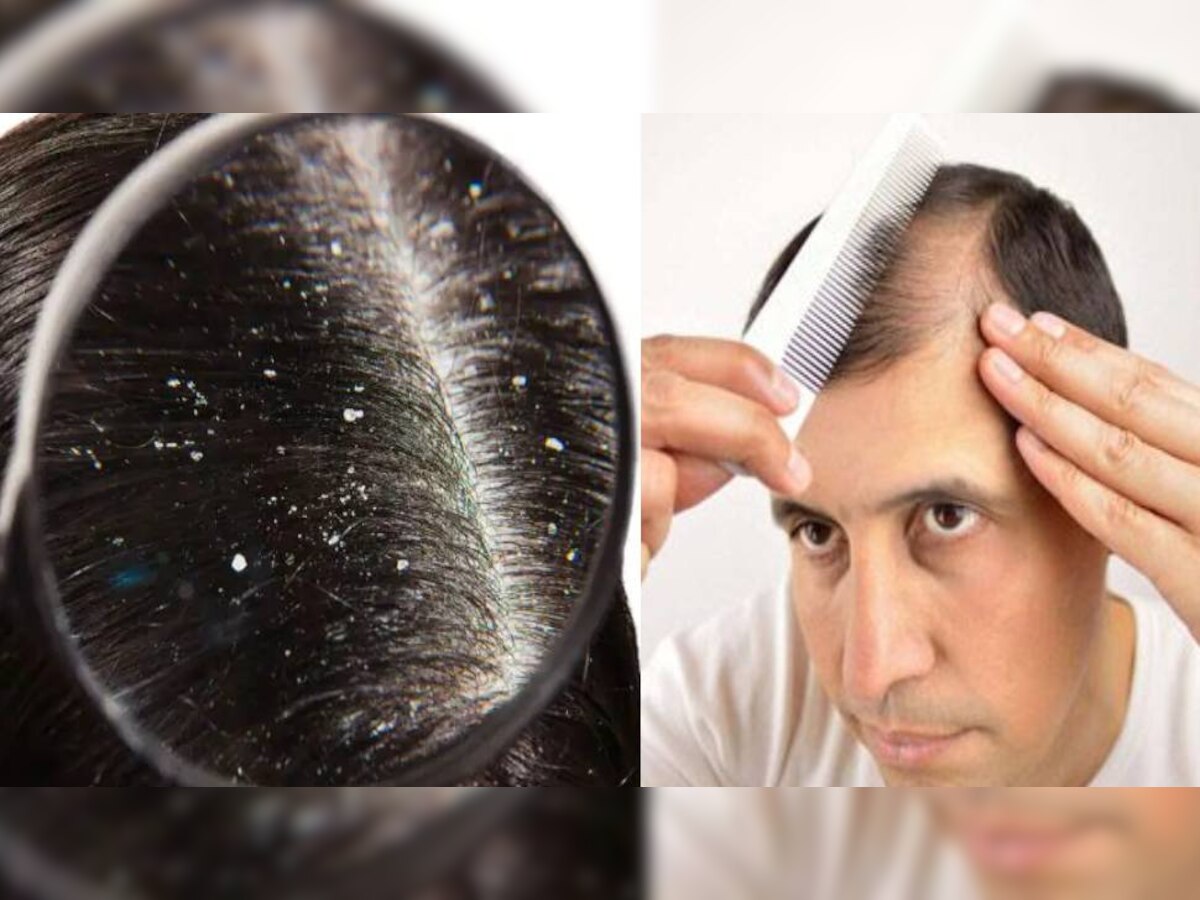 dandruff and hair fall : सांकेतिक तस्वीर