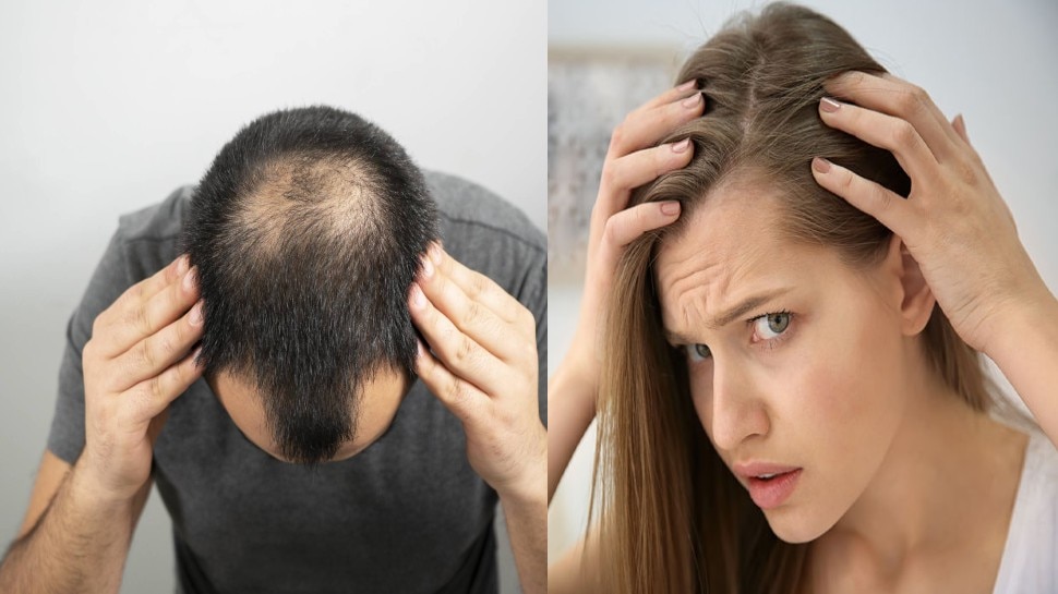 Dry Scalp and Hair Fall Causes Symptoms Home Remedies and Diet to  Prevent Scalp Dryness by Expert in Hindi  डरई सकलप सर क रखपन क  करण और दर करन क घरल