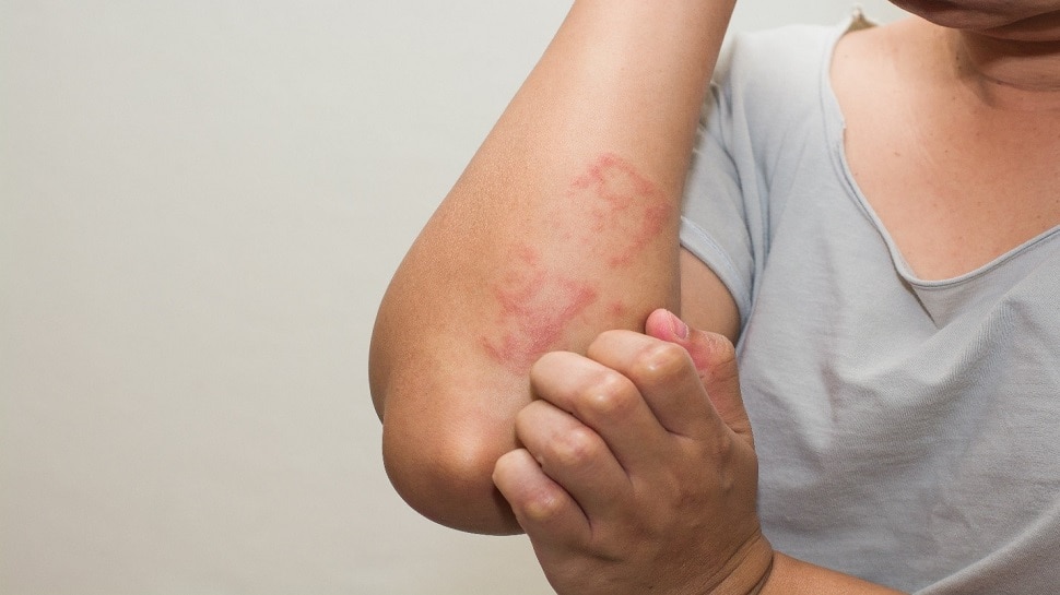 Winter Allergy: सर्दियों में हो सकती हैं ये एलर्जी, बचने के लिए अपनाएं ऐसे टिप्स