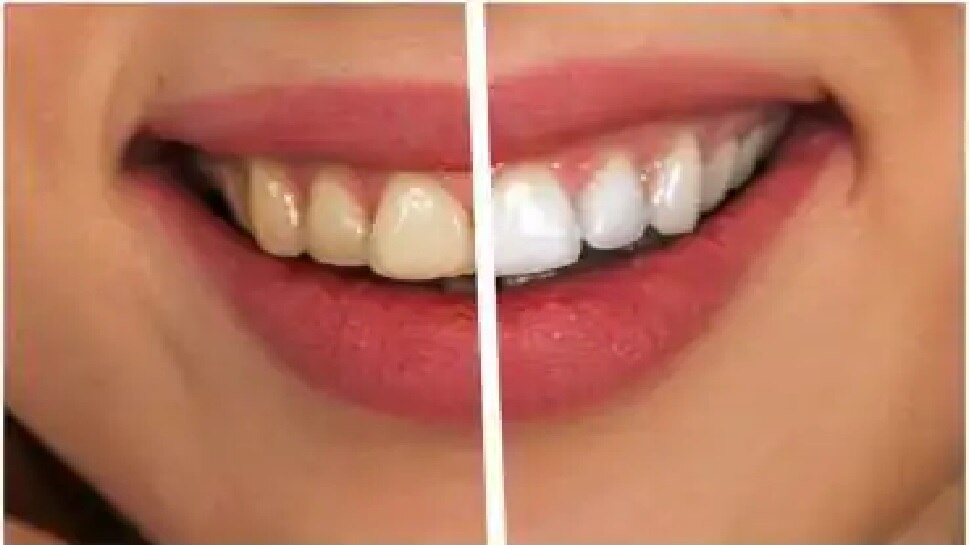 home remedies How to Get Rid of Yellow Teeth सफेद और चमकते दांतों के