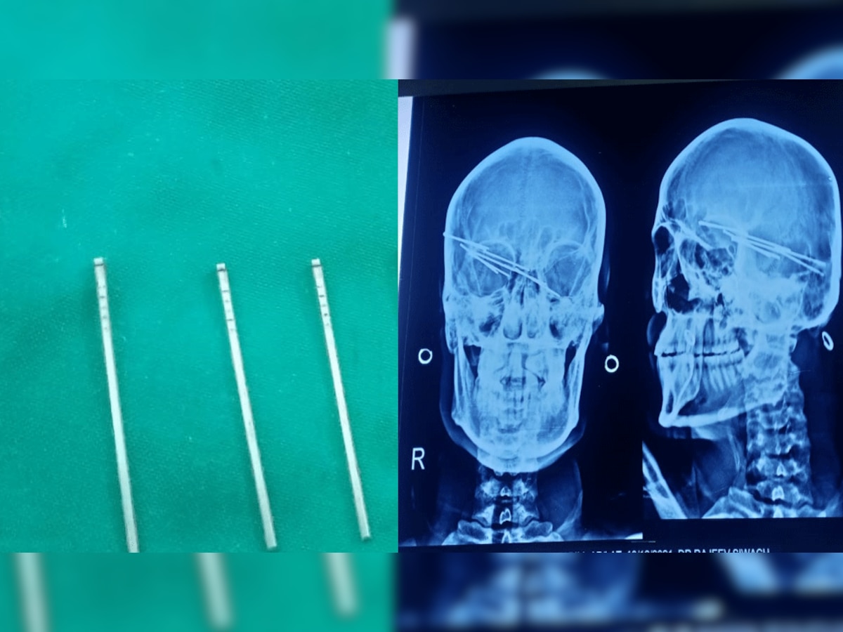 सिर में धंसी 8 कीलें मरीज के दिमाग तक पहुंची, डॉक्टर ने दी ये चौंका देने वाली जानकारी
