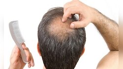 Hair Growth TIPS: इन 2 चीजों से झड़ते बालों की समस्या होगी खत्म, उगने लगेंगे नए बाल