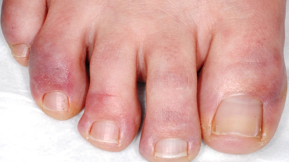 remedies for swelling in hands and toes, swelling of hands and toes