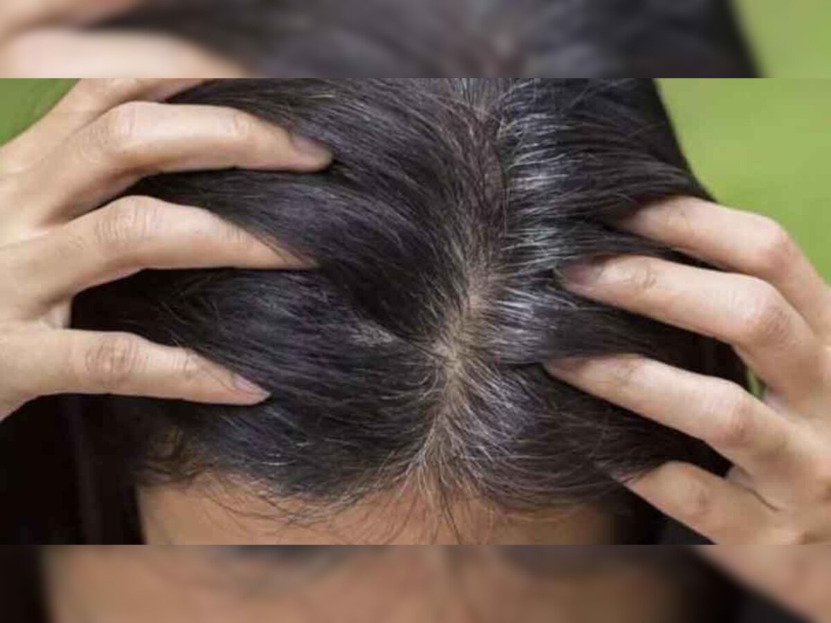 Dandruff cure TIPS: ये 3 चीजें खत्म कर देंगी बालों में डैंड्रफ की समस्या, हेयर हो जाएंगे मुलायम और मजबूत