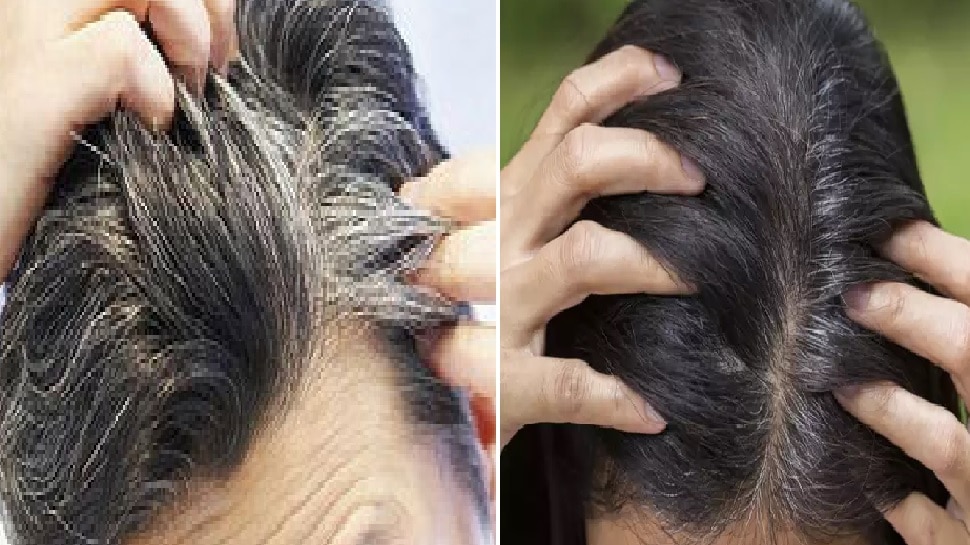 grey hair treatment White Hair Problem कय यग ऐज म दखन लग ह सफद  बल जन इनह कल रखन क तरक  premature grey hair remedies by  expert  Navbharat Times