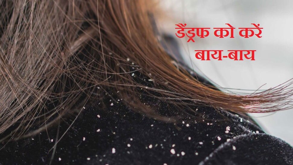 Dandruff Problem 5 Easy Home Remedy Coconut Oil Tea Tree Oil Aloe Vera