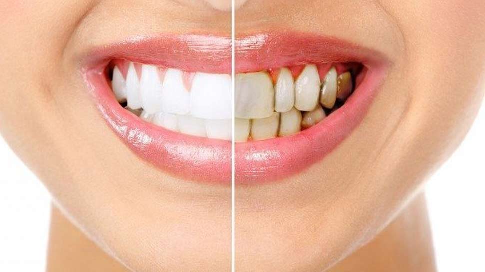 Teeth Staining Foods Tea Candy Tomato Sauce Energy Drinks Carbonated Fruits Blueberry Blackberry
