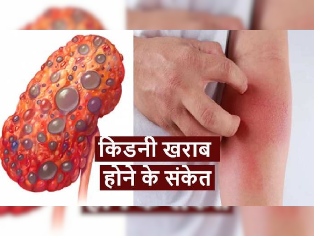 Signs of Kidney Disease: इन शुरुआती लक्षणों से जानें किडनी हो रही है खराब, रहें सतर्क