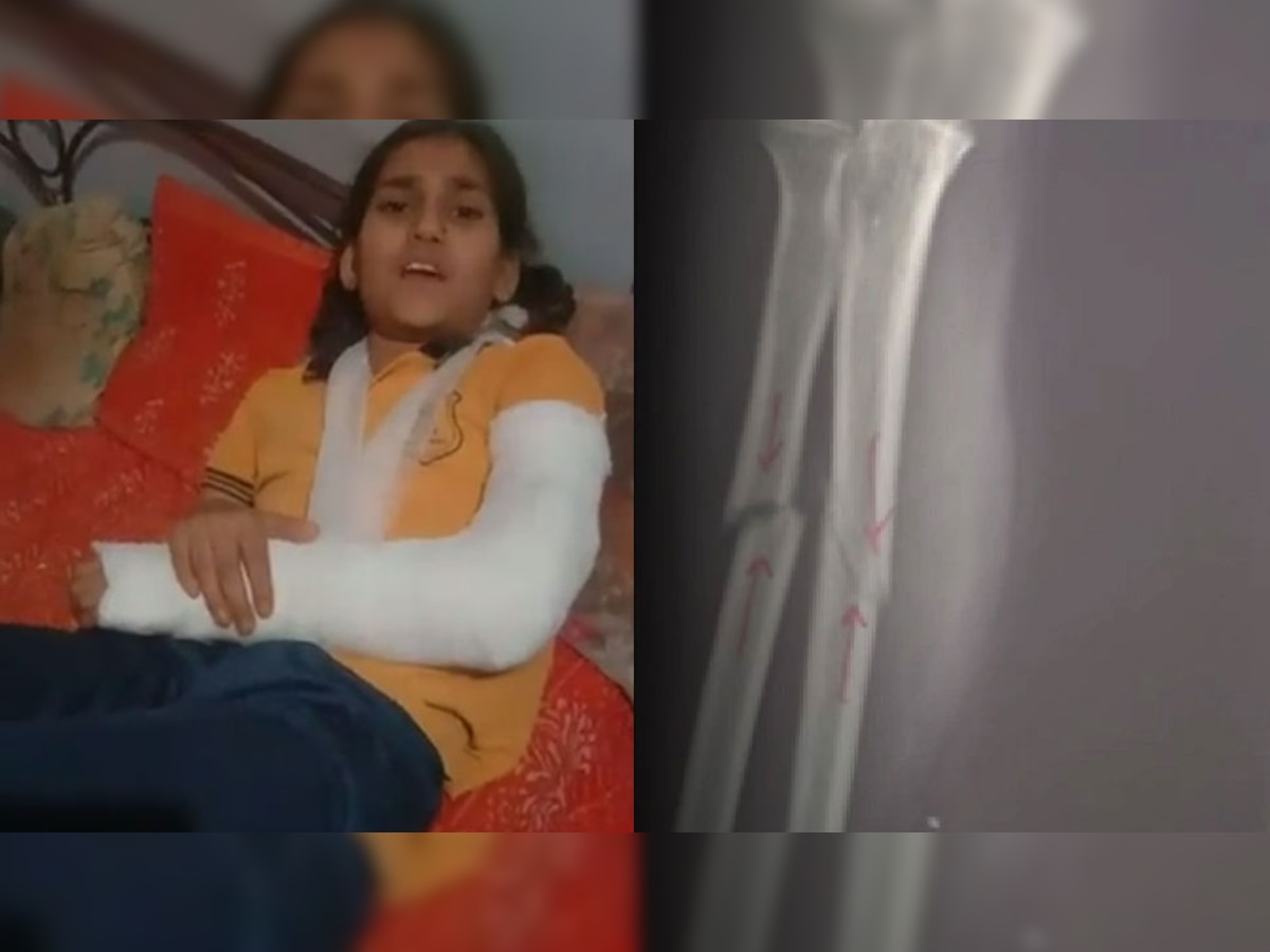 School Student: स्कूल फीस नहीं भरने पर 10 साल की बच्ची की पिटाई, टीचर ने तोड़ा हाथ