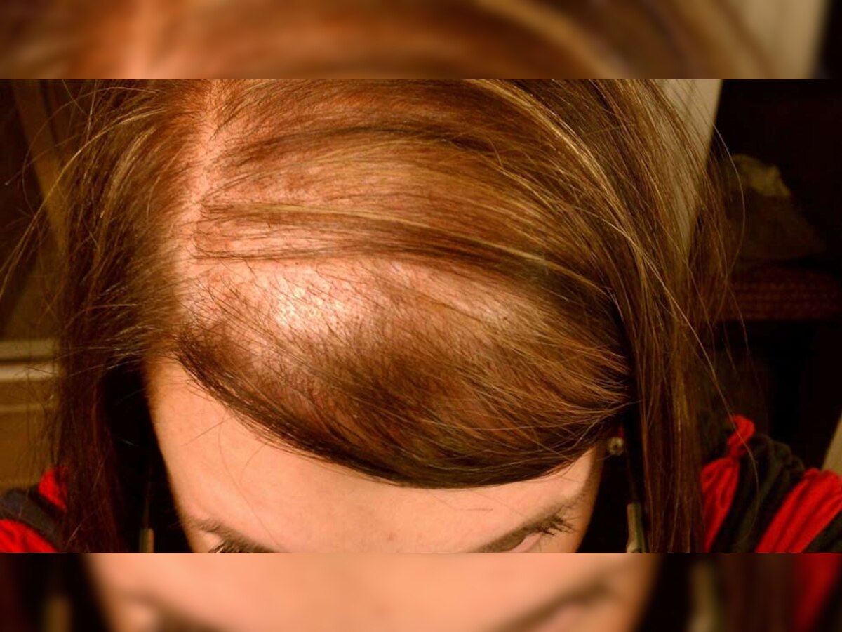 Hair Fall in Women: गंजापन आने से पहले महिलाएं करें ये उपाय, रुक जाएगा हेयर फॉल