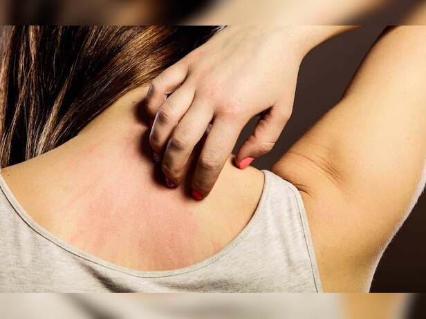 health tips Follow these home remedies avoid heat rash get relief soon ...
