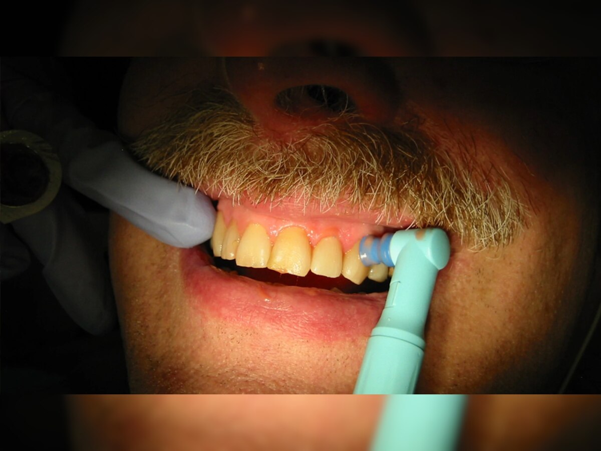 Shocking: डॉक्टर कर रहा था दांतों की सफाई, तभी मरीज निगल गया ये उपकरण; जानें फिर क्या हुआ