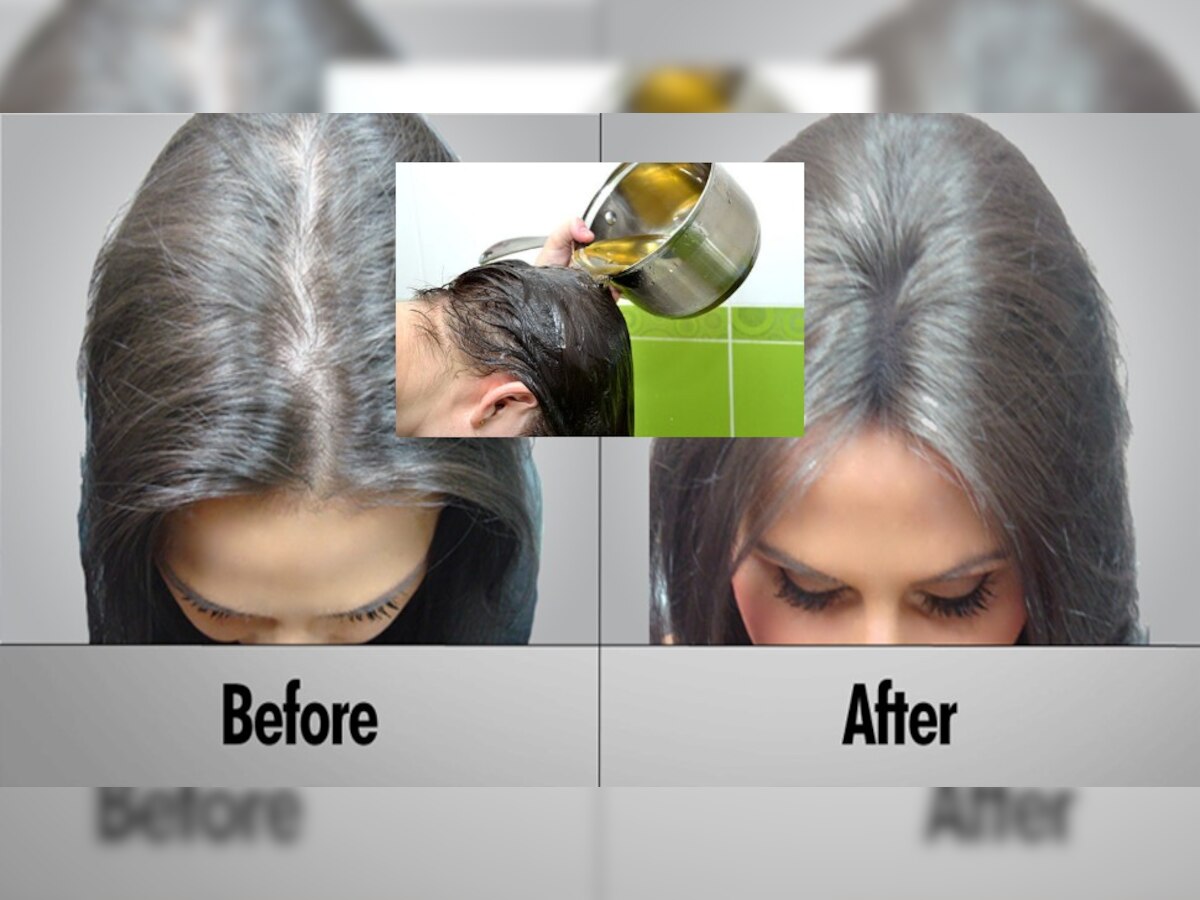 Hair Fall Treatment