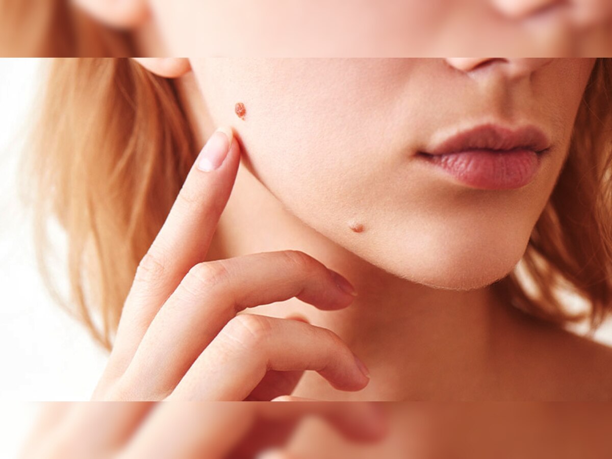 Mole Removal Tips: तिल-मस्से बिगाड़ रहे हैं आपके चेहरे की खूबसूरती? ऐसे पाएं छुटकारा 