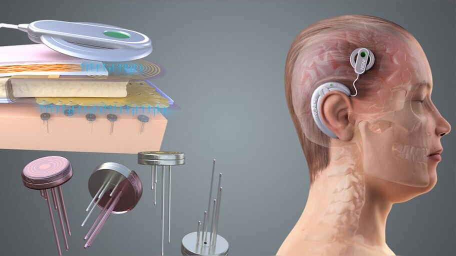 Elon Musk Neuralinks rival company Synchron brain chip trial begins on ...